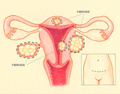 Fibroid